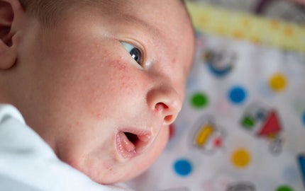 Is That a Rash? Common Baby Skin Conditions and How to Handle Them