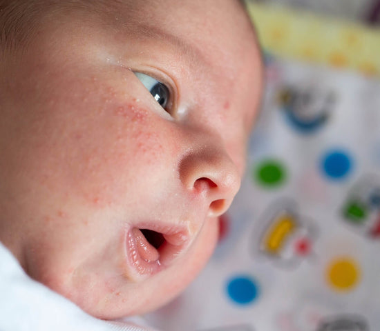 Is That a Rash? Common Baby Skin Conditions and How to Handle Them